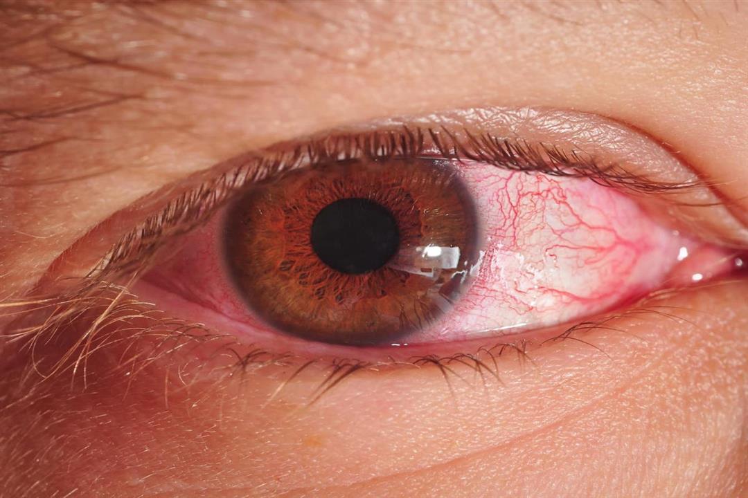 5 علاجات منزلية للالتهاب العين الفيروسي.. متى ترى الطبيب؟