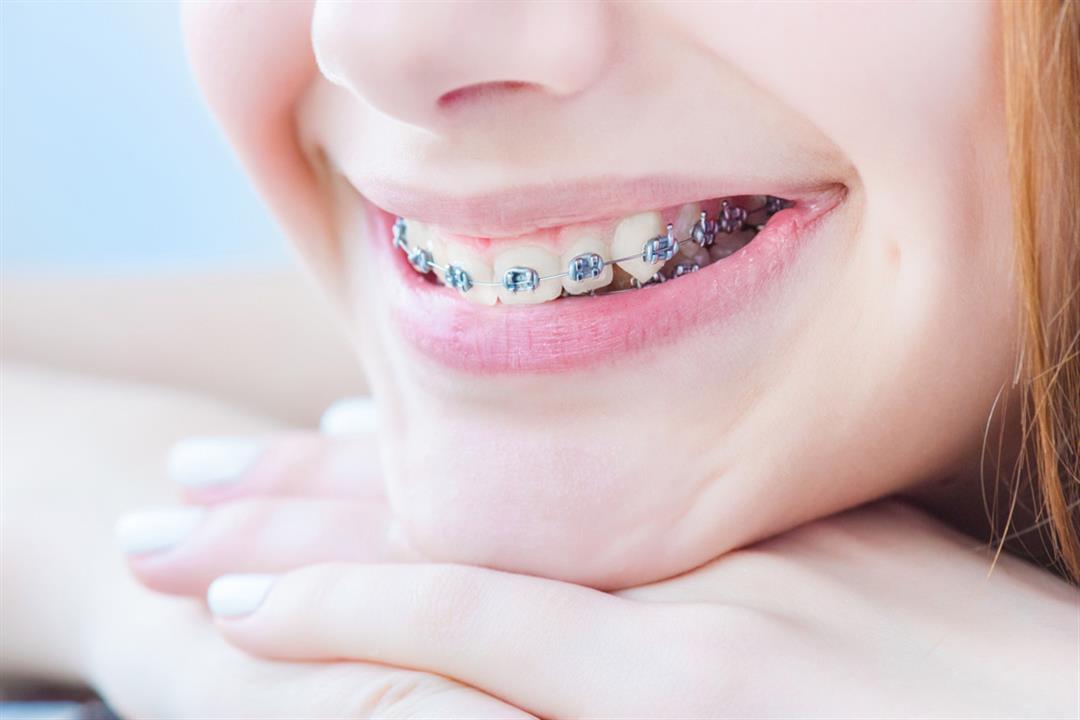 توقف عن تصديقها.. 4 خرافات شائعة عن تقويم الأسنان