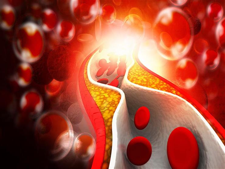 هل ارتفاع نسبة الكوليسترول في الدم يسبب أمراض القلب؟