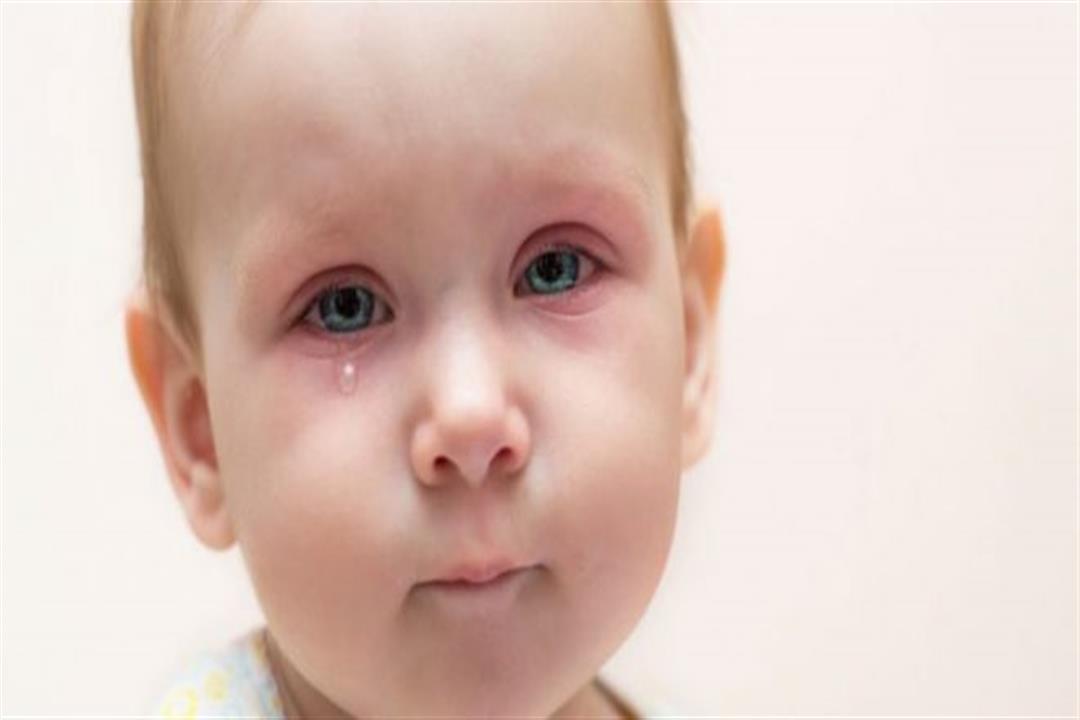  أسباب متعددة لجفاف العين عند الأطفال.. هكذا يمكن العلاج