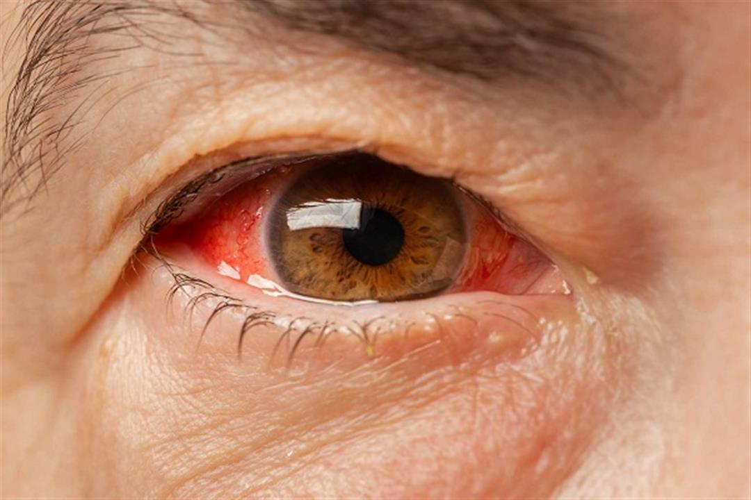 أعراض مزعجة تنذرك بنزيف العين- كيف يمكن العلاج؟
