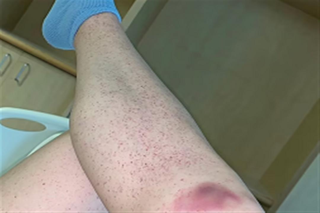 علامات على الجلد