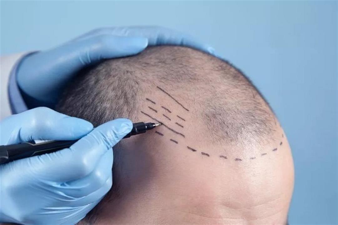 أفضل 5 فيتامينات بعد زراعة الشعر