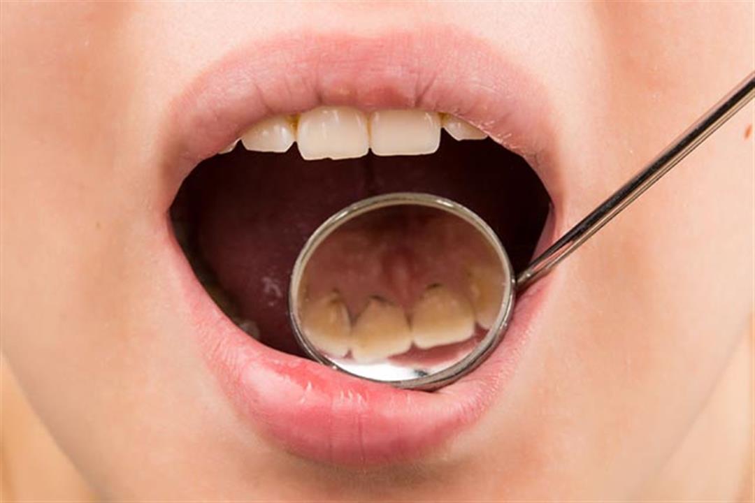 طبيب يحذر من عدم إزالة جير الأسنان: أضراره خطيرة