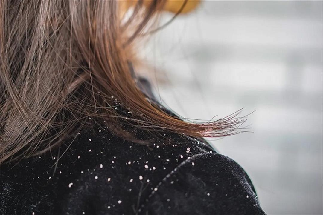 وداعًا لقشرة الشعر في الشتاء- 5 منتجات تنقي فروة رأسك منها