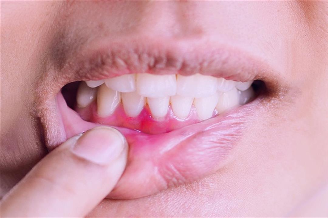 متى يكون ألم اللثة علامة على سرطان الفم؟