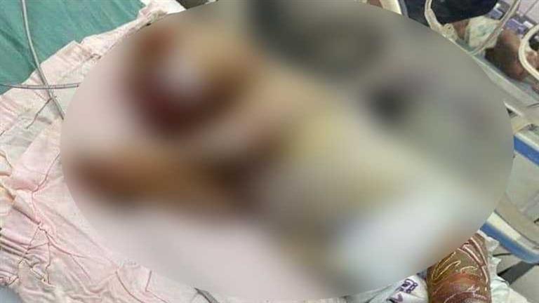 The “wax baby” .. a rare case of birth in Al-Mahalla hospital – photo