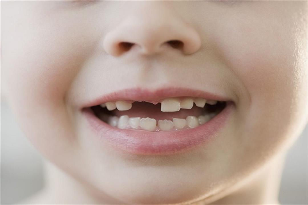 عملية تبديل الأسنان- لماذا تتأخر عند بعض الأطفال؟