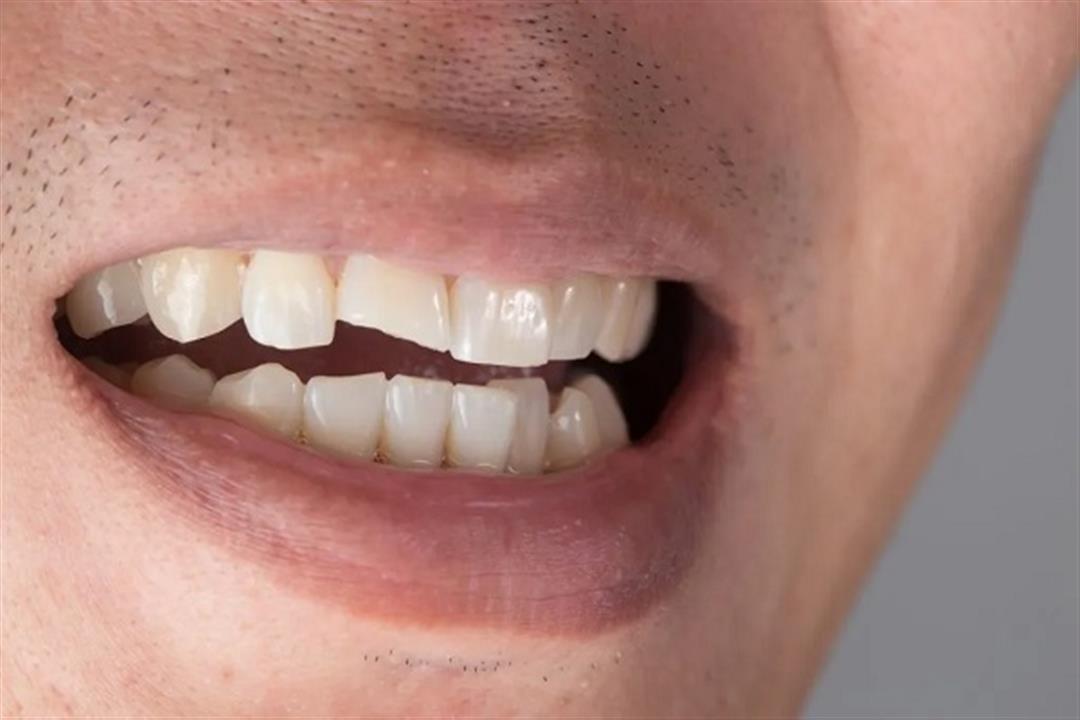 س & ج- دليل شامل عن تآكل الأسنان