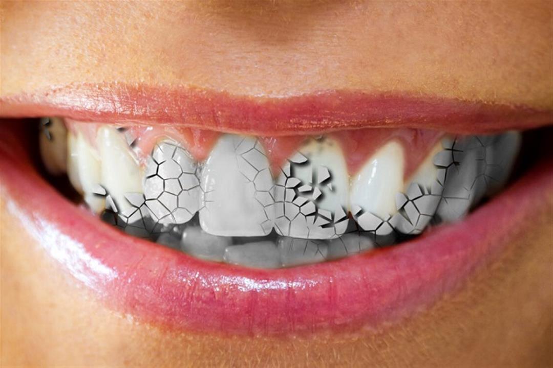 ارتجاع المريء يجعل أسنانك في خطر- ماذا تفعل لحمايتها؟