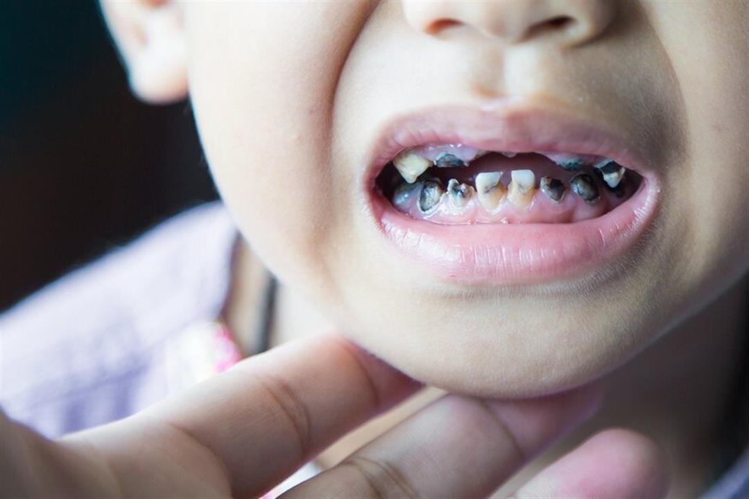 Information about children's tooth discoloration and whether iron ...