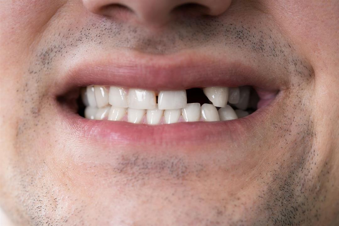 تأثير كورونا على الفم- هل يسبب فقدان الأسنان؟