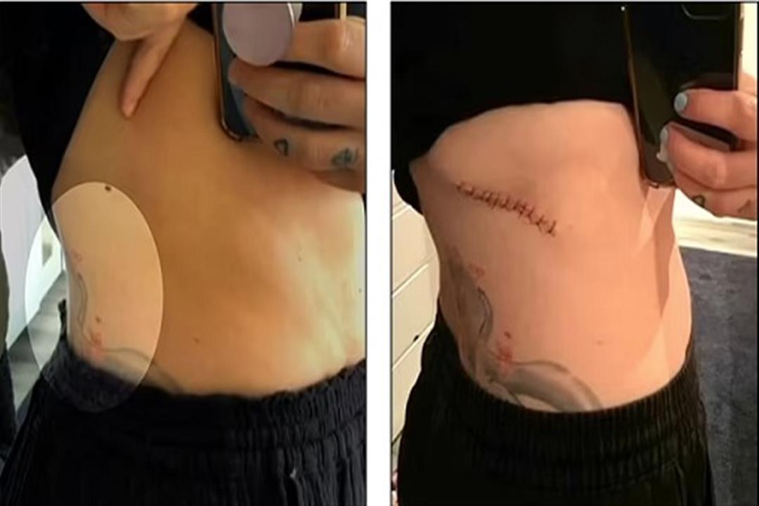 بقعة داكنة صغيرة على الجلد تكشف إصابة امرأة بالميلانوما