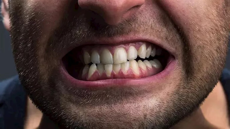 عادة طحن الأسنان.. إليك الأعراض والأسباب وطرق الوقاية 