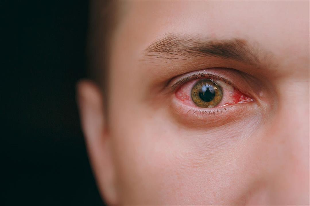 متلازمة سيكا- هل تستدعي زيارة طبيب العيون؟ 