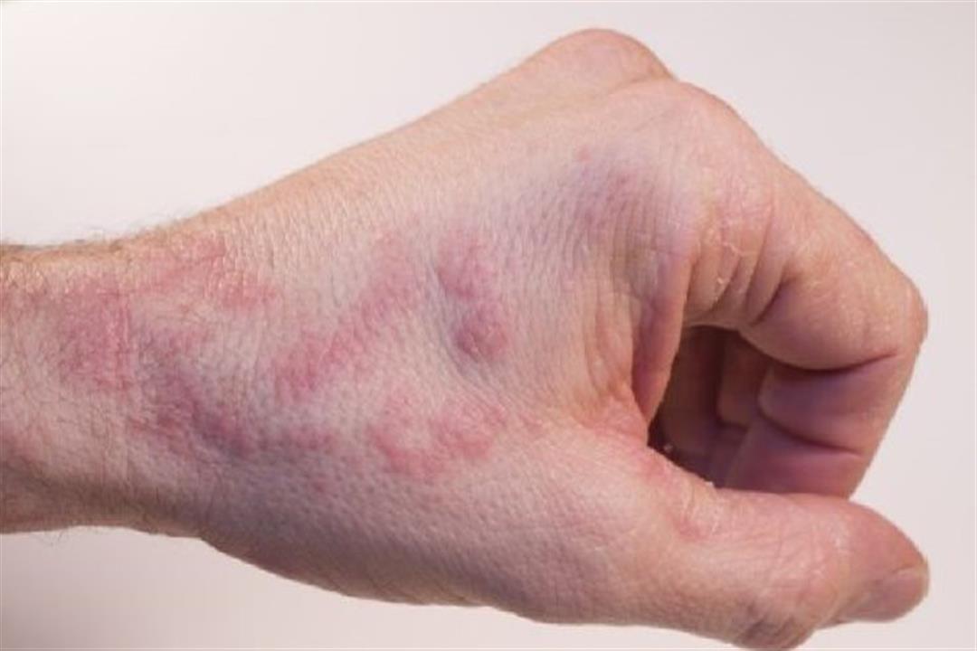 اكزيما تحسسية