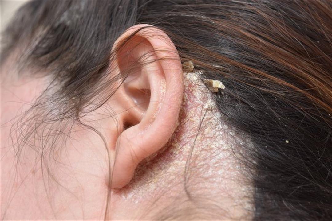 احذر فطريات فروة الرأس- 4 أمراض جلدية قد تصيبك بها