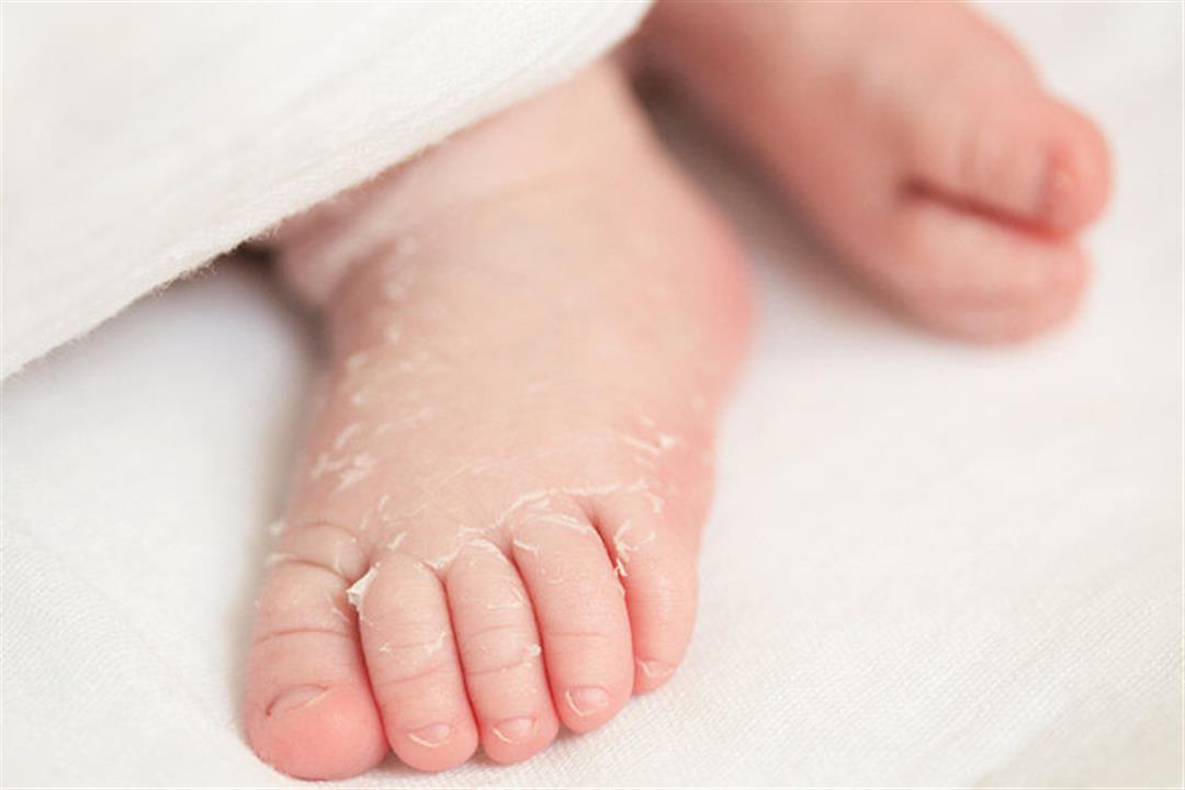 لماذا يتقشر جلد الرضع بعد الولادة؟