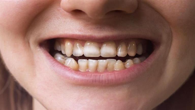 هل إهمال نظافة الأسنان يسبب مشكلات المعدة؟