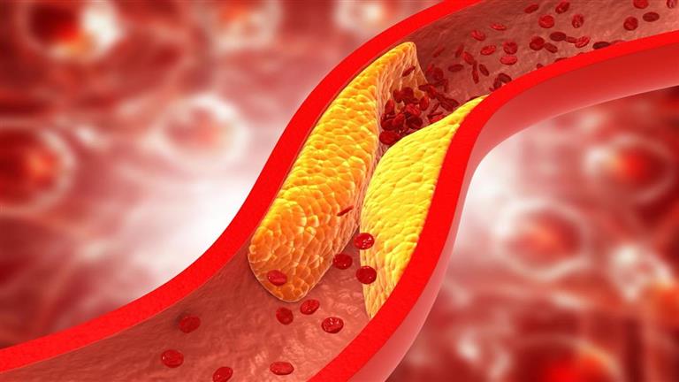 علامة تحذيرية تشير لارتفاع مستوى الكوليسترول في الدم