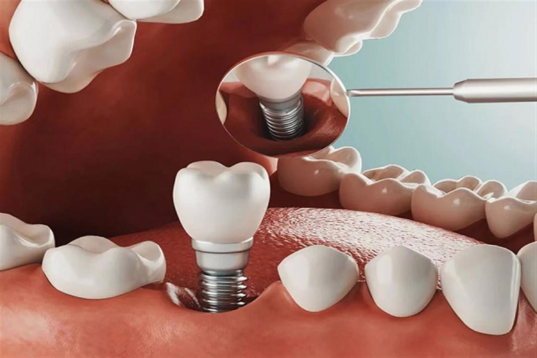 بعد زراعة الأسنان- كيف تتخلص من انتفاخ الخد؟