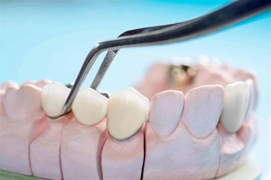 طبيب يحذر من عدم تنظيف تركيبات الأسنان في رمضان- إليك الأضرار