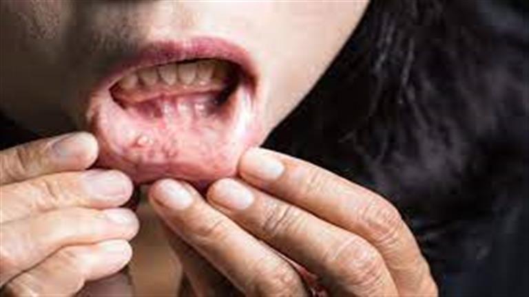 لا تتجاهلها- علامات قد تكشف الإصابة بسرطان الفم