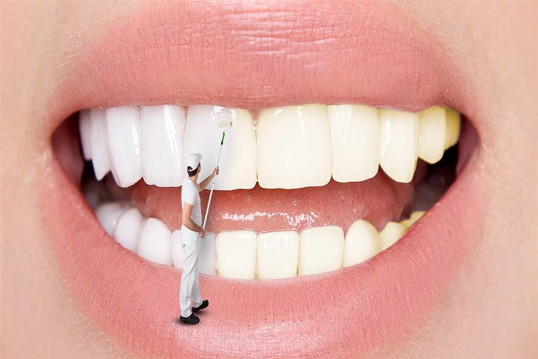 5 أسباب لظهور بقع الأسنان البيضاء.. هكذا تتخلص منها