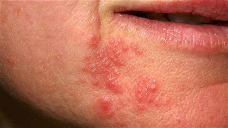 بخلاف الجدري- 7 أمراض تسبب الطفح الجلدي