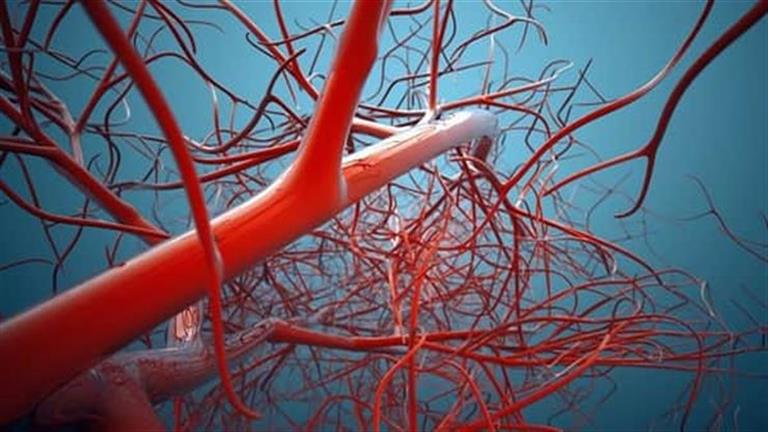 6 أضرار خطيرة لتقلص الأوعية الدموية- إليك أسبابه