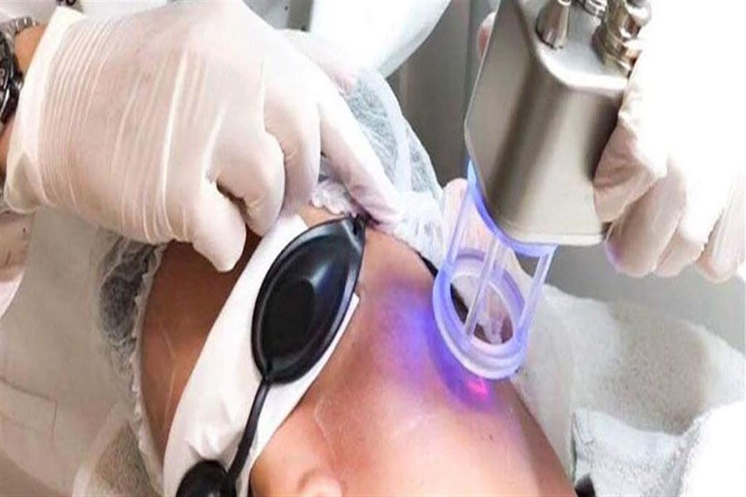 التقشير بالليزر