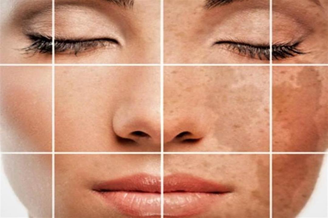 5 طرق مختلفة للتخلص من تصبغات الوجه (صور)