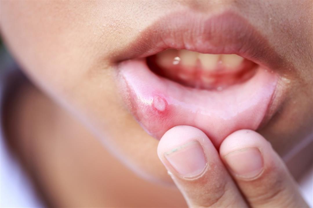 متى تدل تقرحات الفم على الإصابة بالسرطان؟
