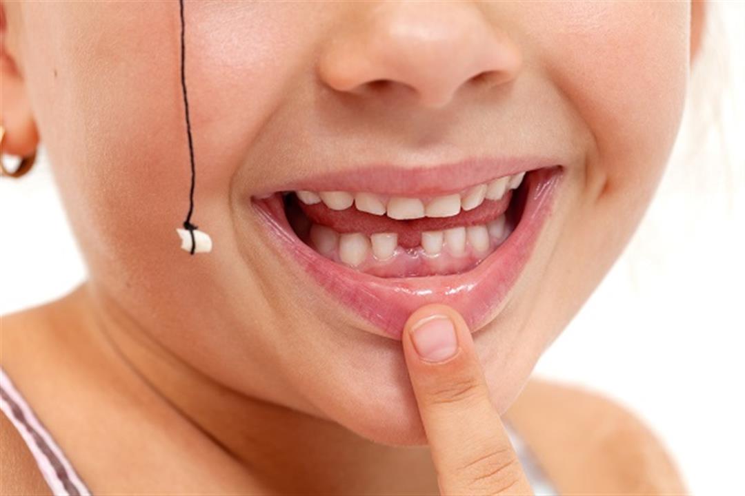 طبيب يكشف خطورة خلع الأسنان اللبنية للطفل مبكرًا
