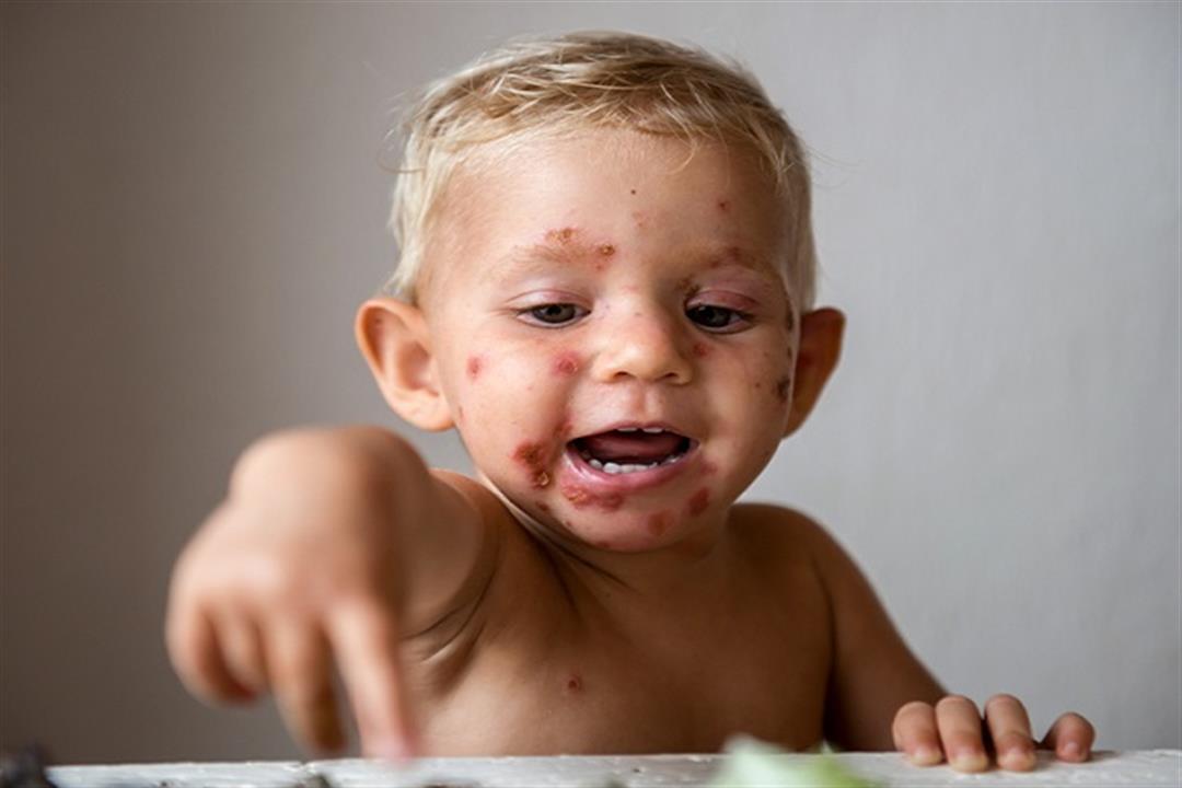 أمراض جلدية قد تصيب طفلِك في الصيف- هكذا تحميه