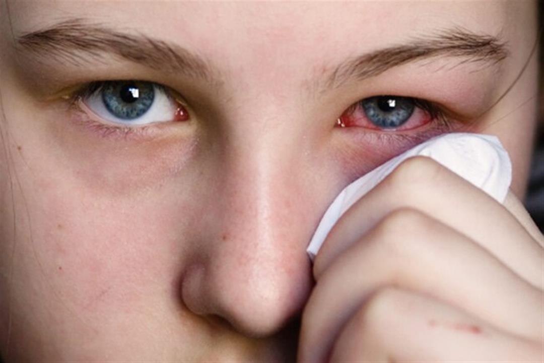 أسباب متعددة لنزيف العين- متى يستدعي الذهاب إلى الطبيب؟