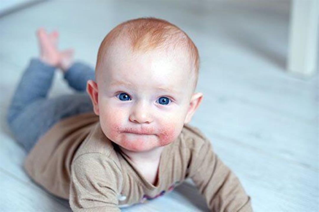 أنوع الطفح الجلدي عند الرضع– متى يكون خطيرًا؟