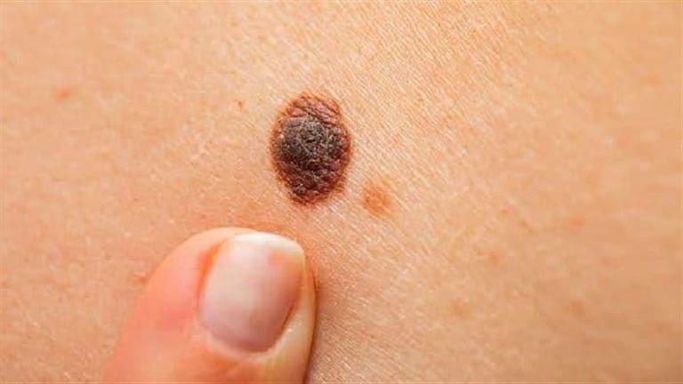 5 مناطق غير متوقعة بالجسم تكشف إصابتك بسرطان الجلد
