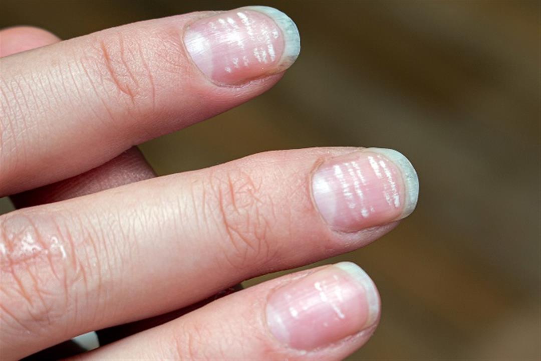 nail_damage_white_lines-1277450093