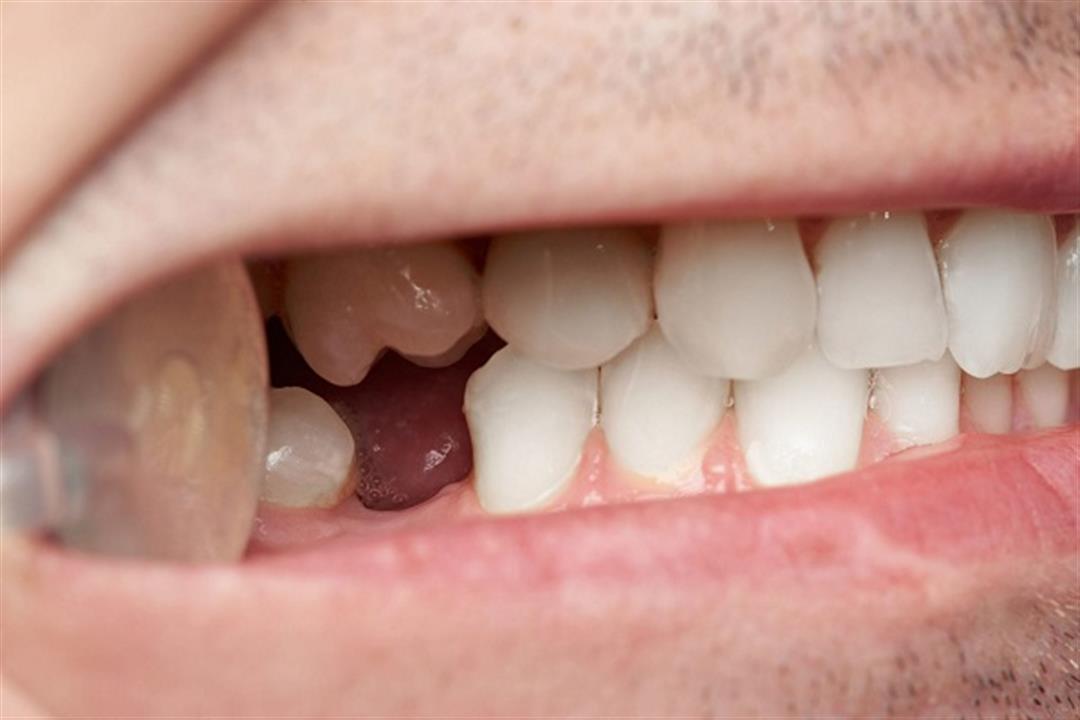 3 مشكلات يسببها السكري لصحة الفم والأسنان