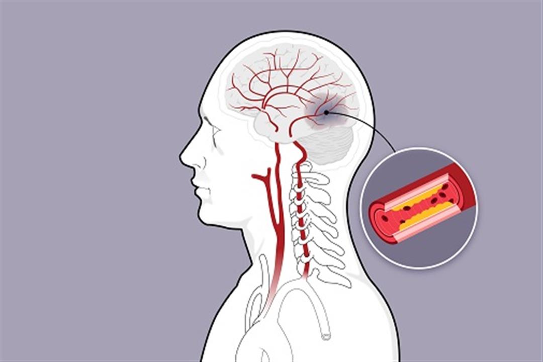 السكتة الدماغية- 9 فئات أكثر عرضة للإصابة بها