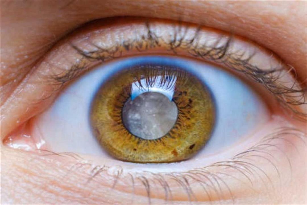 طبيب عيون يحذر: هذا المرض يسبب العمى
