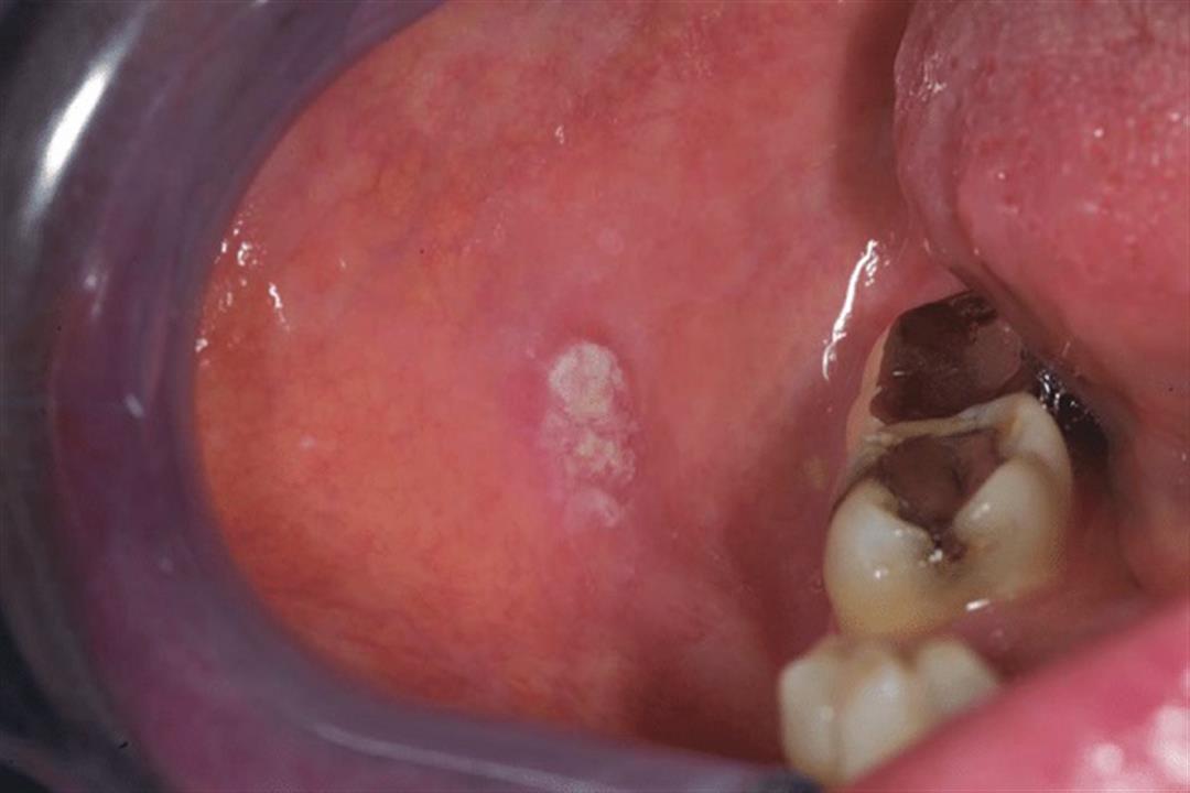 طبيبة تحذر من سرطان تجويف الفم: هذه أعراضه