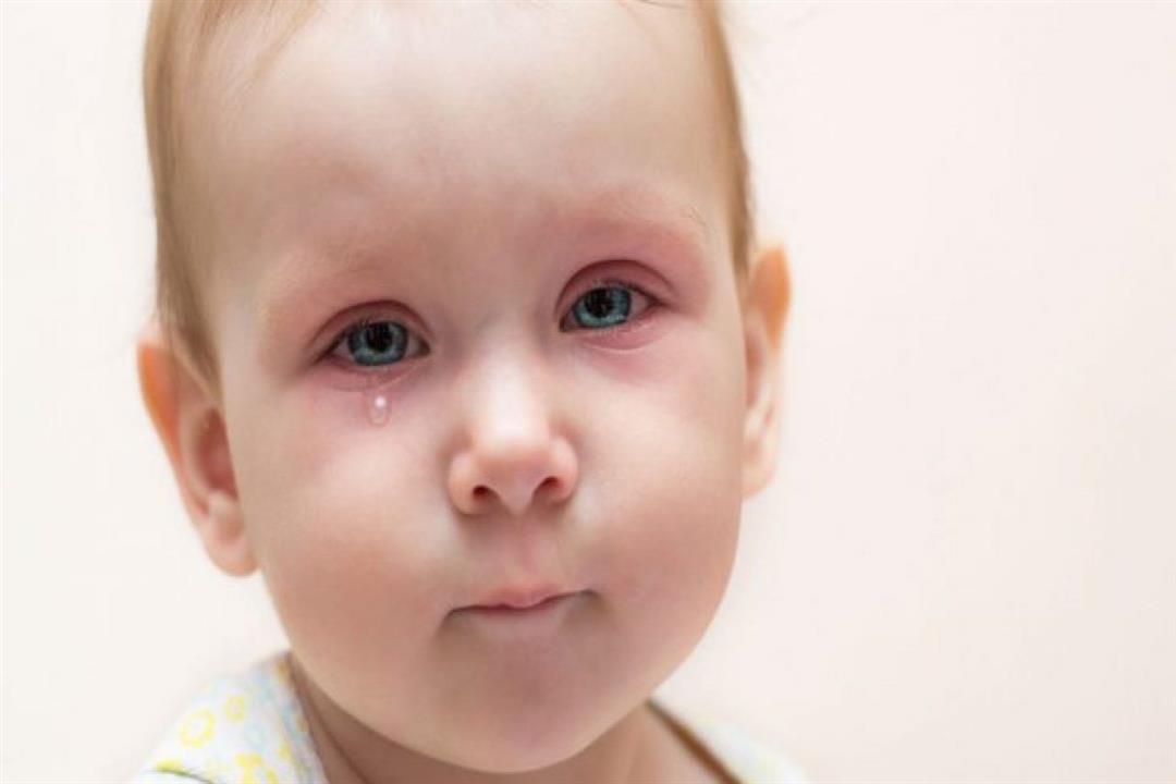 7 أسباب لتورم عين الرضع.. هل تهدد الطفل؟