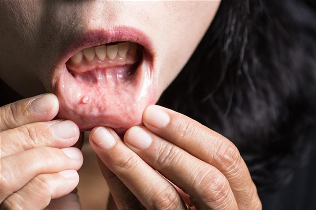 أعراض سرطان الفم- 8 علامات أولية لا تتجاهلها