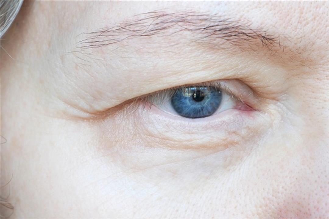 طبيب يحذر من الجلوكوما: تسبب العمى في هذه الحالة