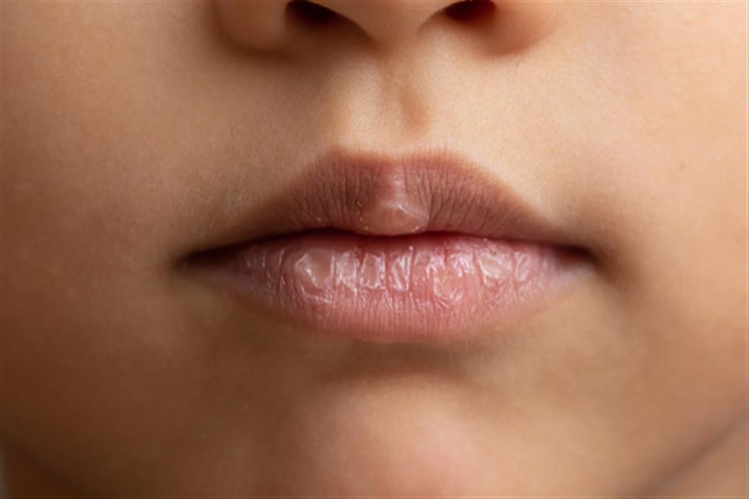 جفاف الفم في رمضان- كيف تتجنبه؟