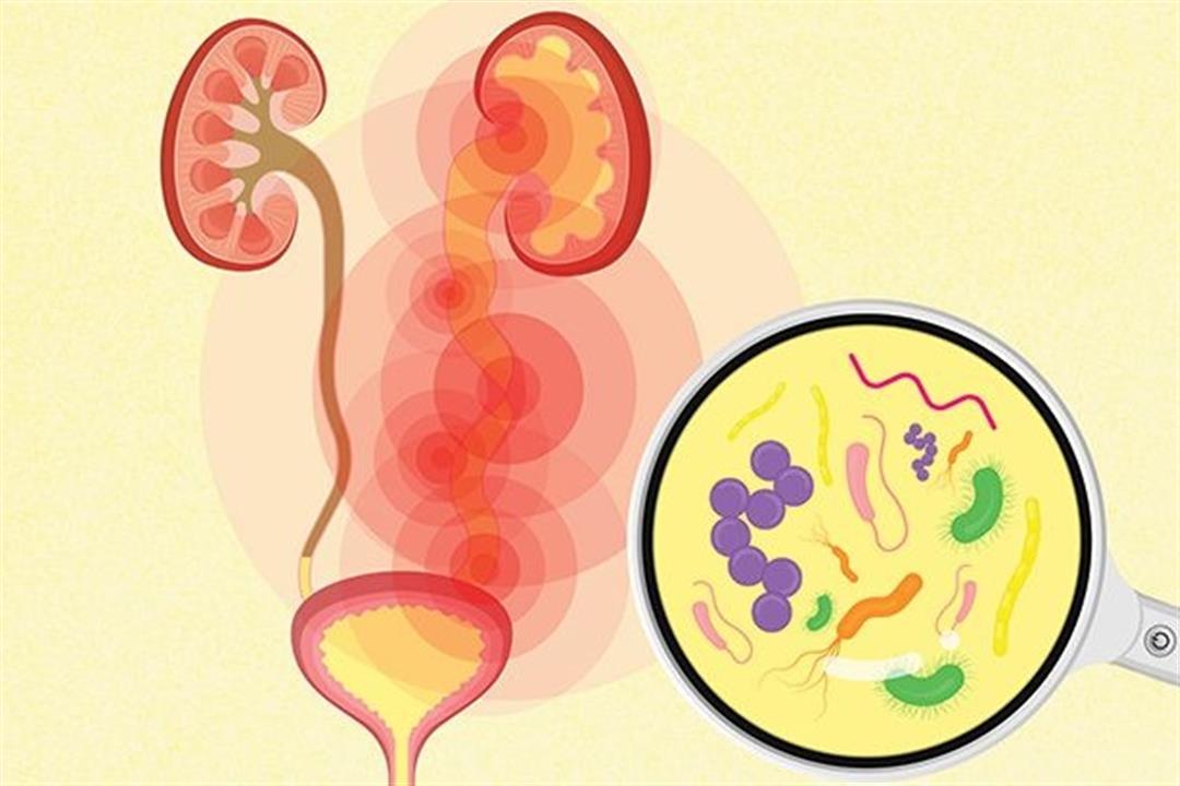 كيف تتجنب الإصابة بالتهاب المسالك البولية؟