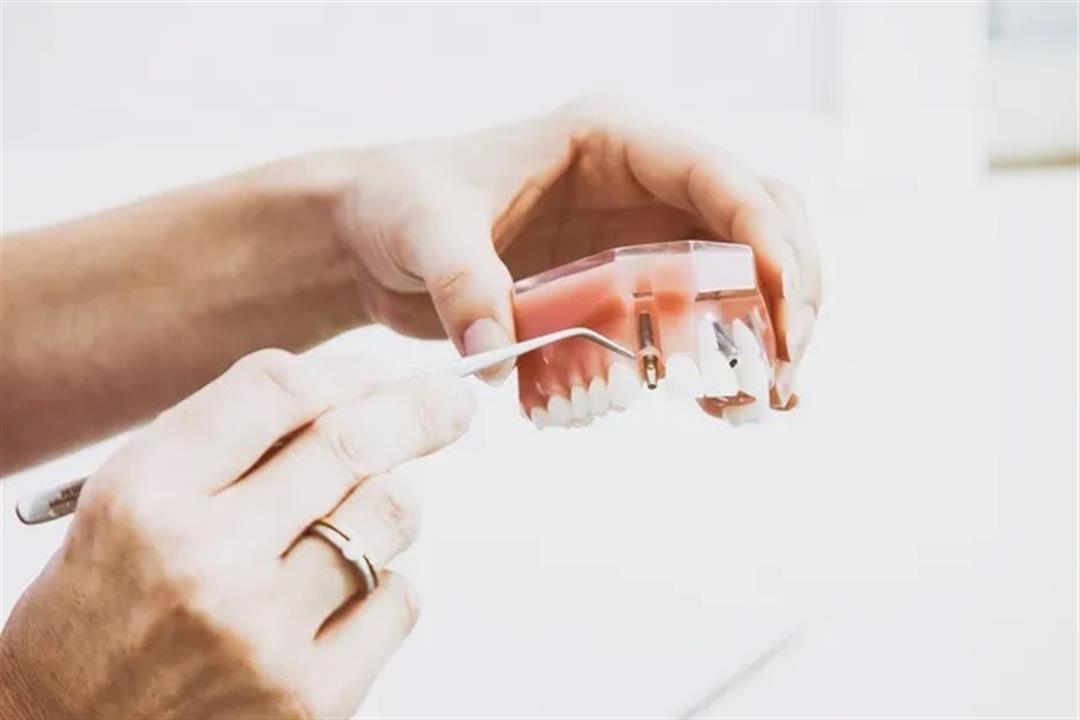 ما الذي يجب فعله قبل زراعة الاسنان؟- طبيبة توضح "فيديو"