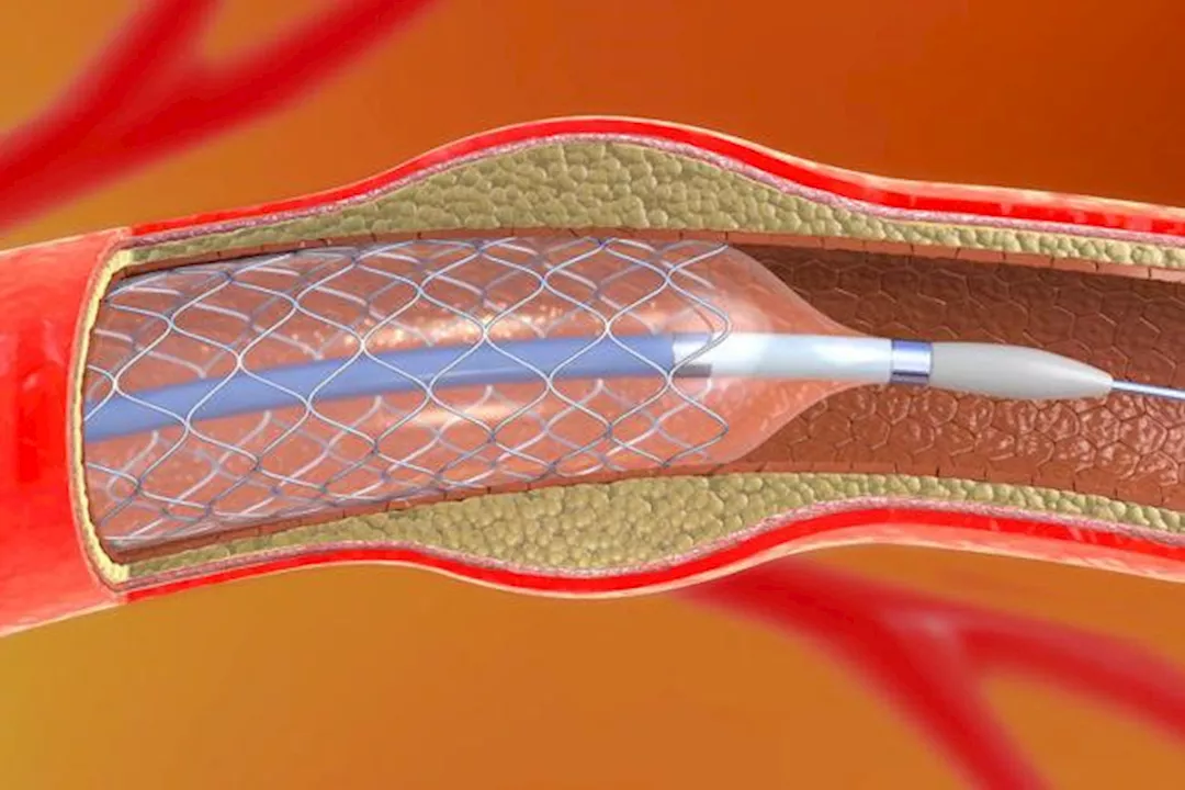بعد تركيب دعامات القلب.. نصائح مهمة لا تغفلها